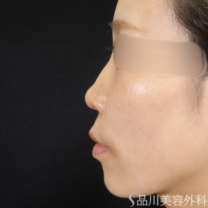 症例NO.70657のBEFORE写真