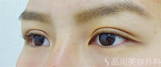症例NO.34443のAFTER写真