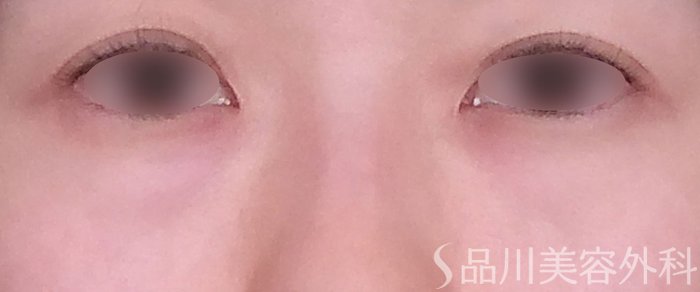 症例NO.70059のBEFORE写真