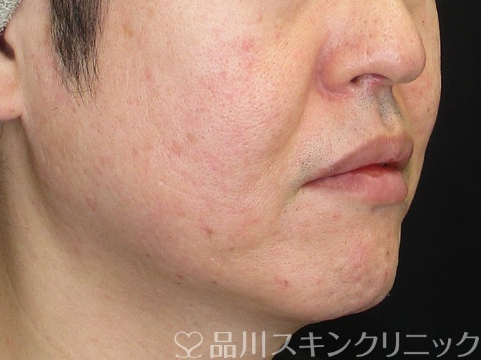 症例NO.73263のAFTER写真