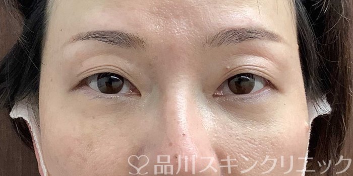 症例NO.71292のAFTER写真
