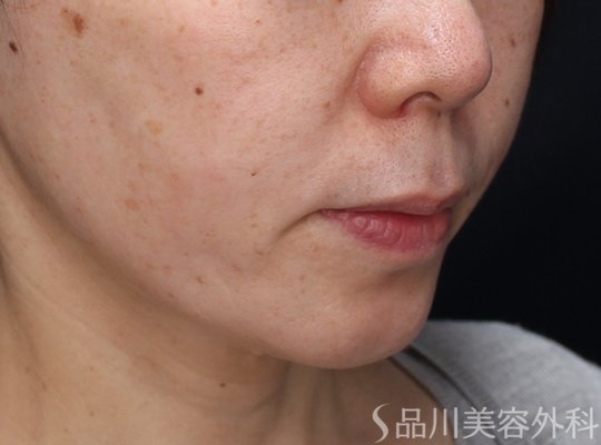 症例NO.73098のAFTER写真