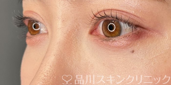 症例NO.63455のAFTER写真