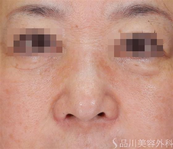 症例NO.60415のAFTER写真