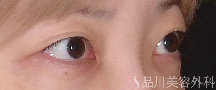 症例NO.70886のBEFORE写真