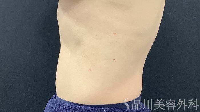 症例NO.75386のAFTER写真