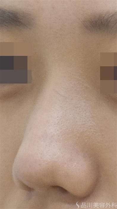 症例NO.53312のAFTER写真