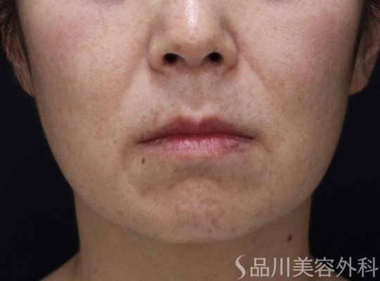 症例NO.73385のBEFORE写真