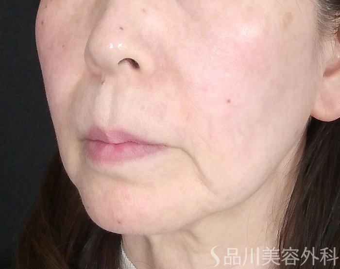 症例NO.69699のBEFORE写真
