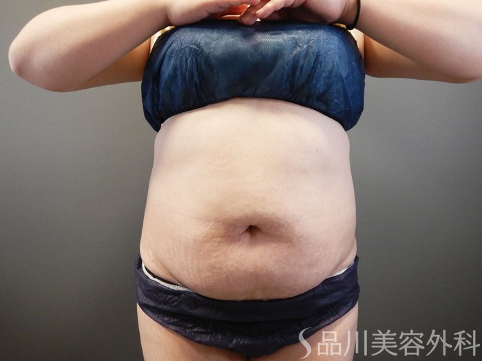 症例NO.64956のAFTER写真