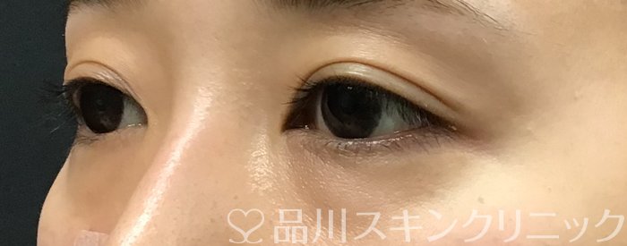 症例NO.69447のBEFORE写真