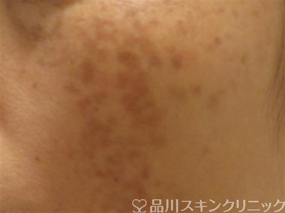 症例NO.38042のBEFORE写真