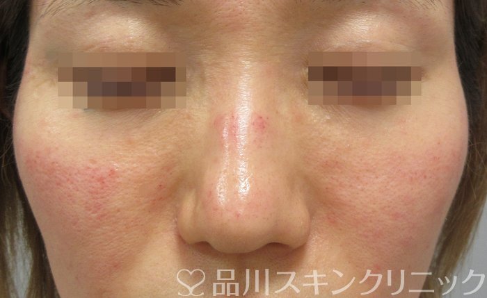 症例NO.70185のBEFORE写真