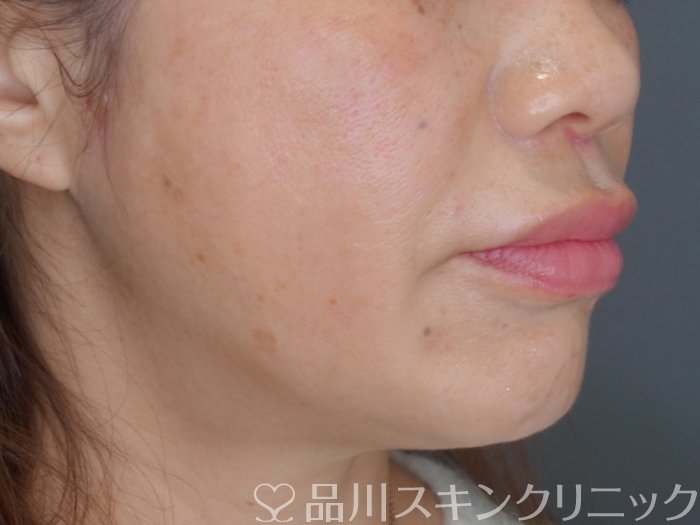 症例NO.73658のAFTER写真