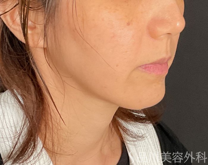 症例NO.74813のBEFORE写真