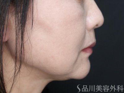 症例NO.74149のAFTER写真