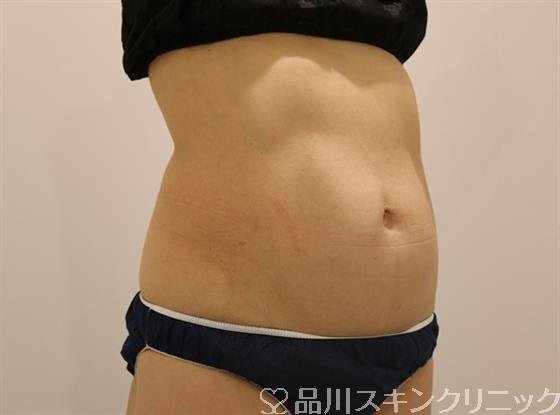 症例NO.43180のBEFORE写真