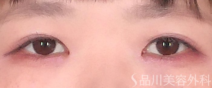 症例NO.70595のAFTER写真