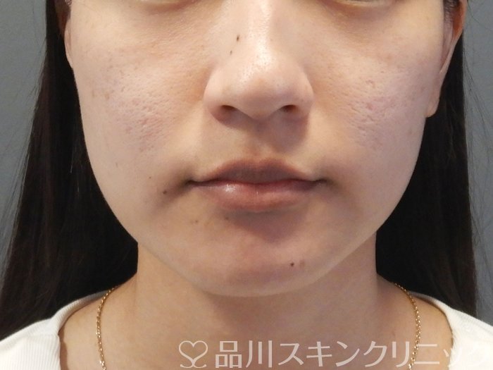 症例NO.73327のBEFORE写真