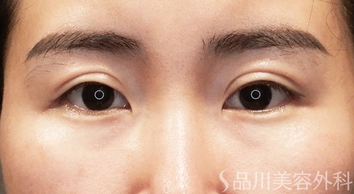 症例NO.70823のAFTER写真