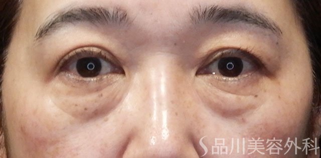 症例NO.64130のBEFORE写真