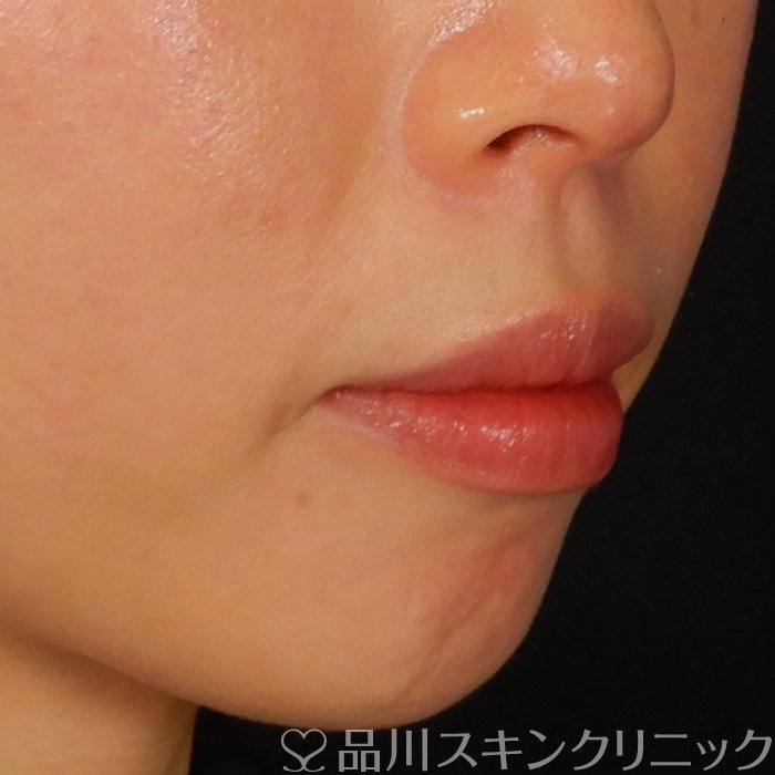 症例NO.67243のBEFORE写真