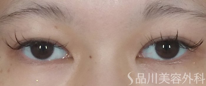 症例NO.67646のBEFORE写真