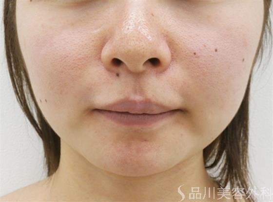 症例NO.24993のBEFORE写真