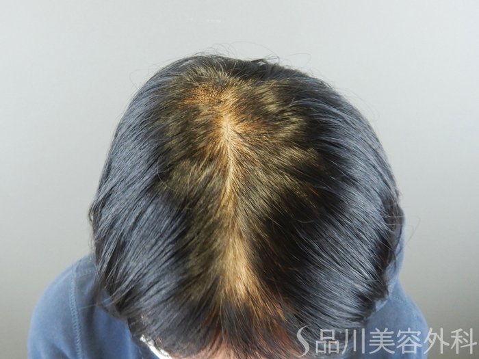症例NO.65233のBEFORE写真