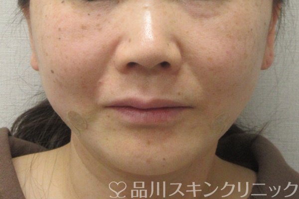 症例NO.74163のAFTER写真