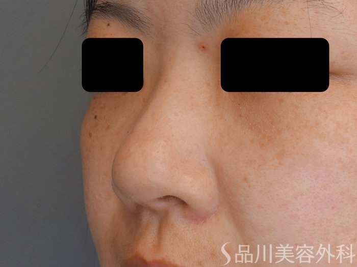 症例NO.71433のBEFORE写真