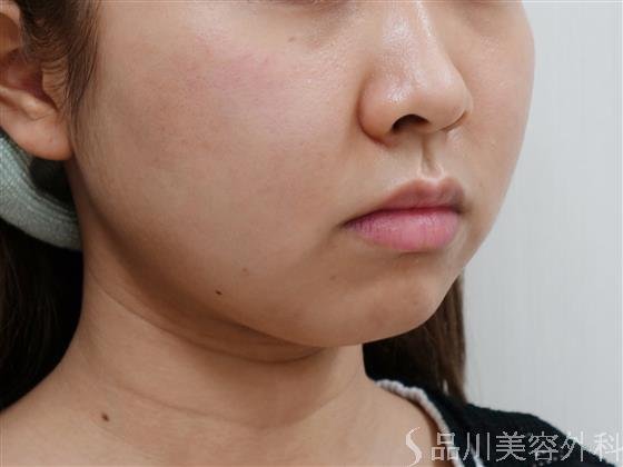 症例NO.29792のBEFORE写真