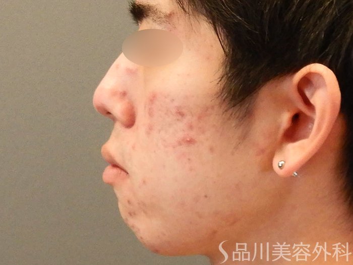 症例NO.67922のBEFORE写真