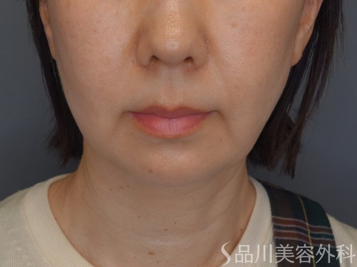 症例NO.74657のAFTER写真