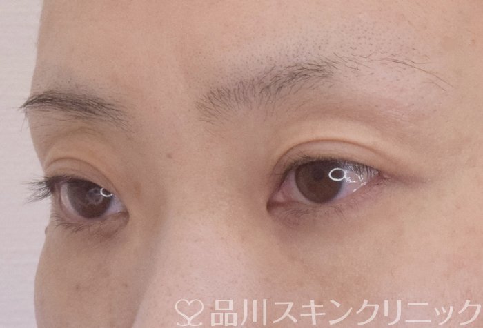 症例NO.64812のBEFORE写真