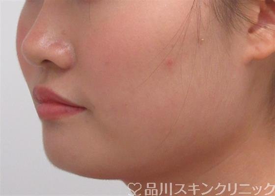 症例NO.31056のAFTER写真