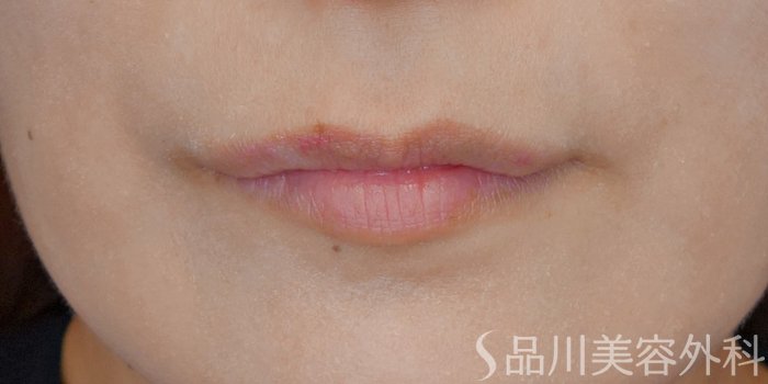 症例NO.72139のBEFORE写真