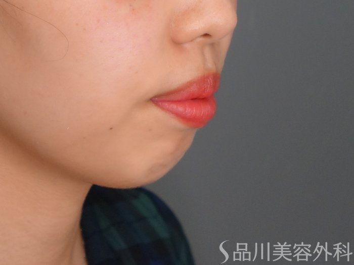 症例NO.69878のBEFORE写真