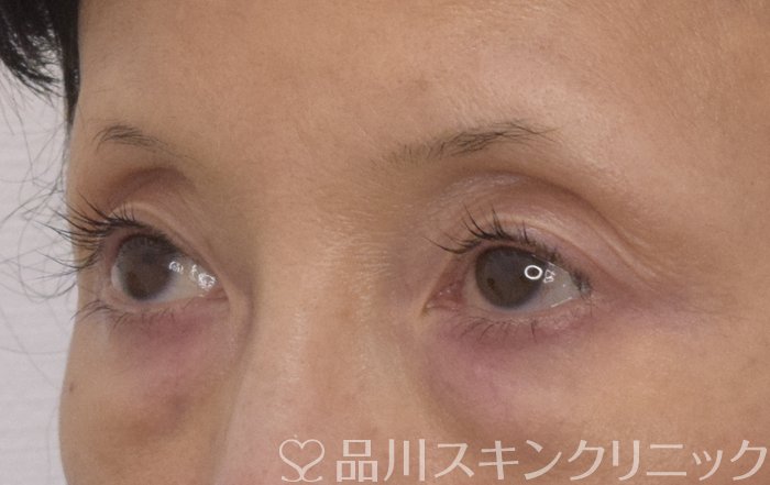 症例NO.69556のBEFORE写真