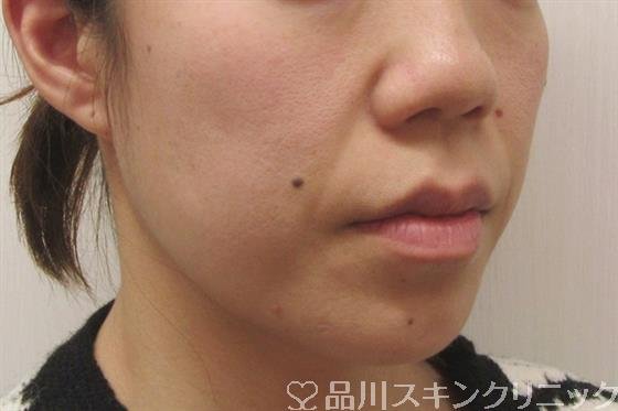 症例NO.57877のBEFORE写真