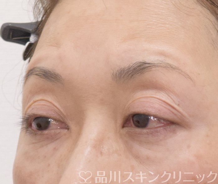 症例NO.74052のBEFORE写真