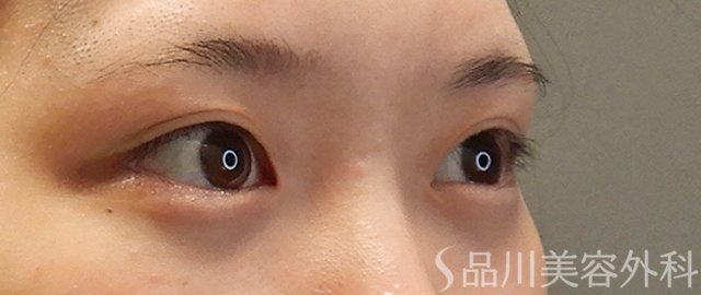 症例NO.71692のBEFORE写真