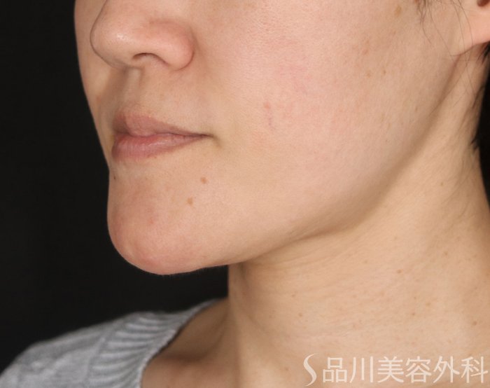 症例NO.73185のBEFORE写真