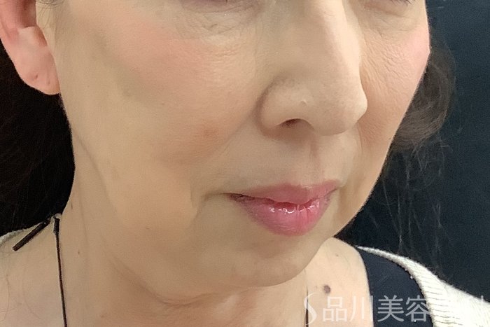 症例NO.71244のBEFORE写真