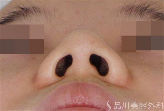 症例NO.50988のBEFORE写真
