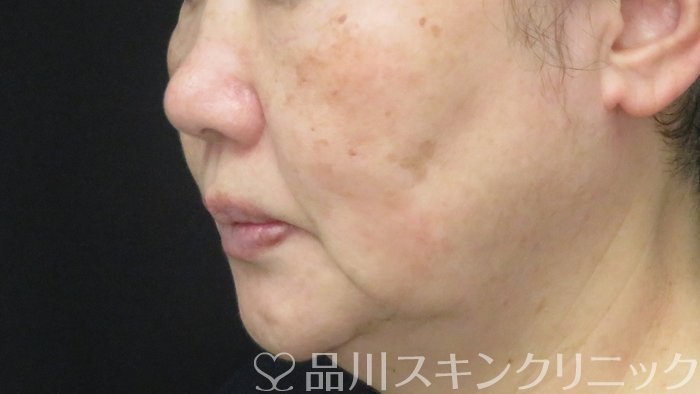 症例NO.72194のBEFORE写真