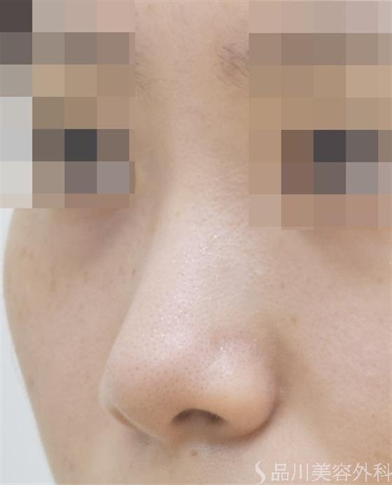 症例NO.44619のBEFORE写真