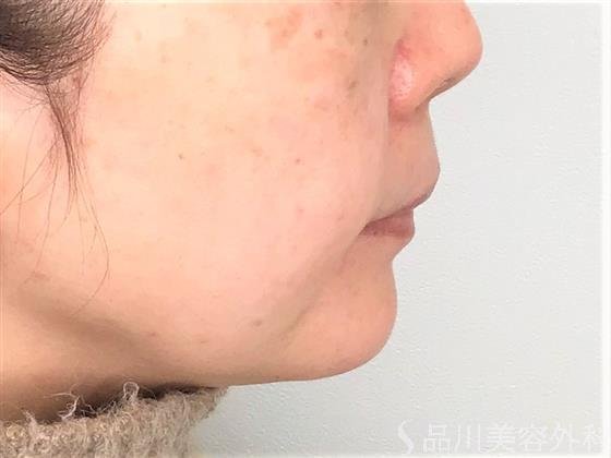 症例NO.58041のAFTER写真