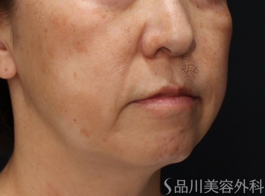 症例NO.72705のBEFORE写真