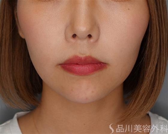 症例NO.52403のAFTER写真